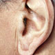 همه چیز درباره جراحی و زیبایی گوش