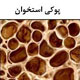 عوامل مساعد‌کننده ابتلا به پوکی استخوان