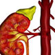 عفونت کلیه Pyelonephritis