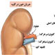 تصفیه‌گر خون